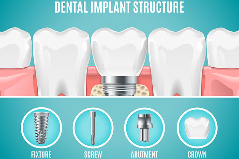 vellore-dental-implant-structure